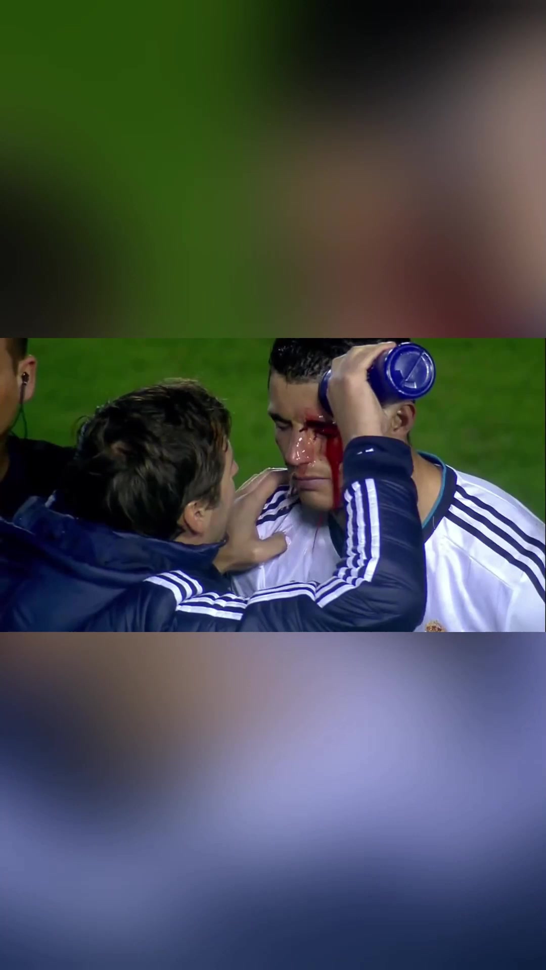 硬汉C罗眉骨破裂现场缝针单眼进球霸气回击对手